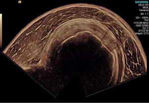 Технология SieScape™ обеспечивает анатомическую детализацию панорамных изображений — например, УЗ-исследование плечевого сустава ACUSON S1000 HELX